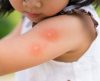 Dia Mundial da Alergia: veja o que você precisa saber sobre o problema! - Jornal da Franca