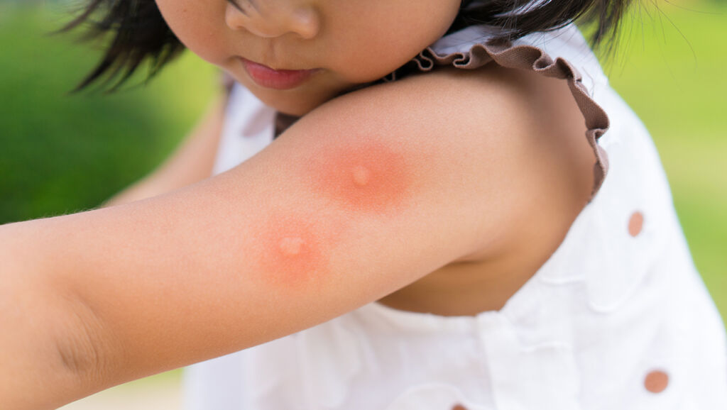 Dia Mundial da Alergia: veja o que você precisa saber sobre o problema!