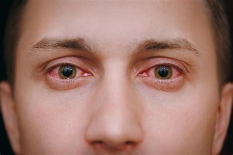 Conheça as causas para a vermelhidão dos olhos: pode ser um sinal de atenção - Jornal da Franca
