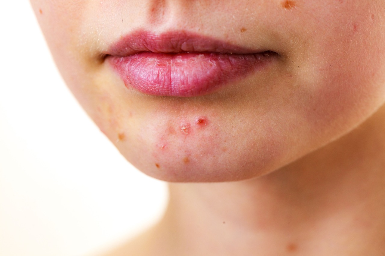 Uso indevido de remédios para acne pode causar problemas, afirma Sociedade Médica