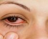 Vermelhidão constante nos olhos é um sinal de alerta e merece cuidados. Saiba mais - Jornal da Franca