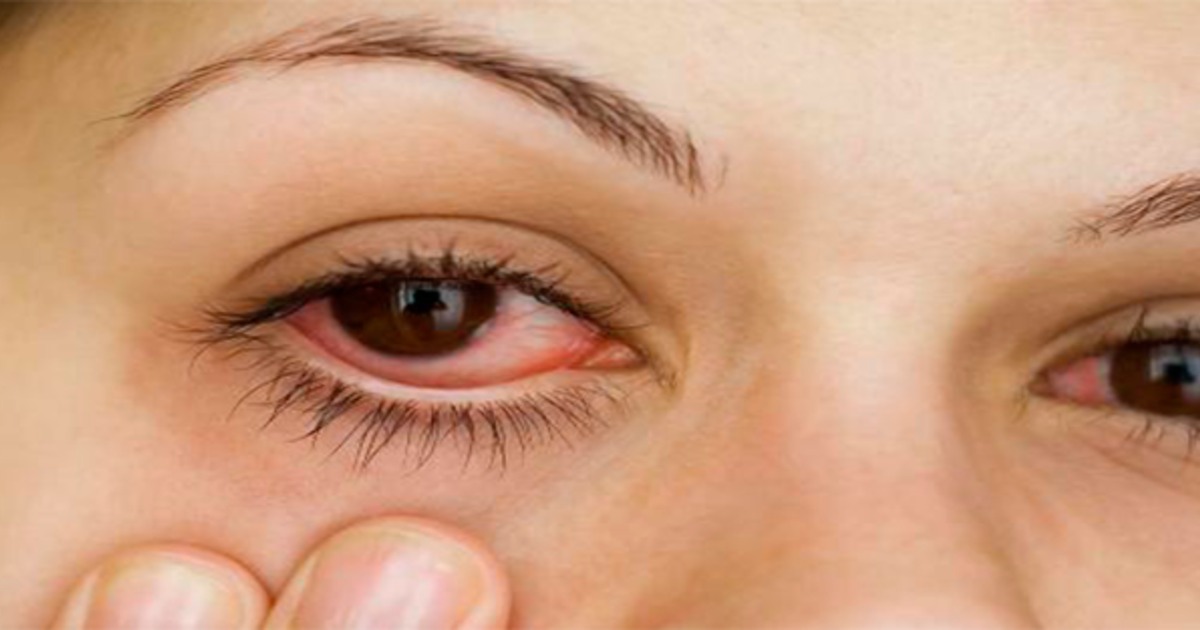 Dor E Vermelhidão Nos Olhos - NAZAEDU
