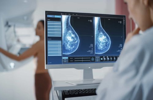 42% das mulheres nunca fizeram mamografia por se considerarem jovens - Jornal da Franca