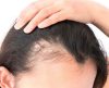 Alopecia: saiba quando a queda de cabelo vira um problema de saúde - Jornal da Franca