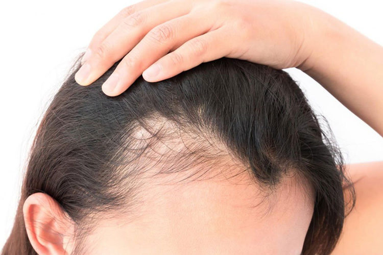 Alopecia: saiba quando a queda de cabelo vira um problema de saúde