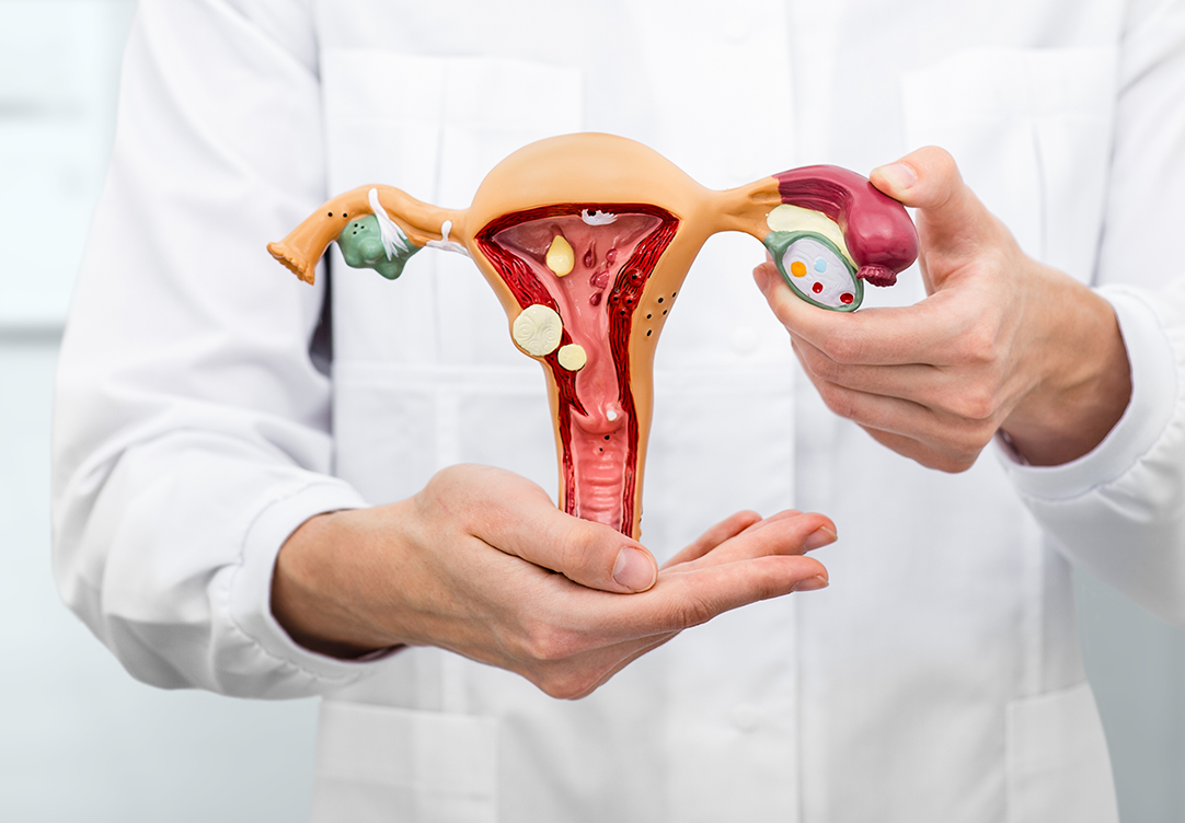 Miomas podem se tornar gigantes sem tratamento. Conheça os sintomas