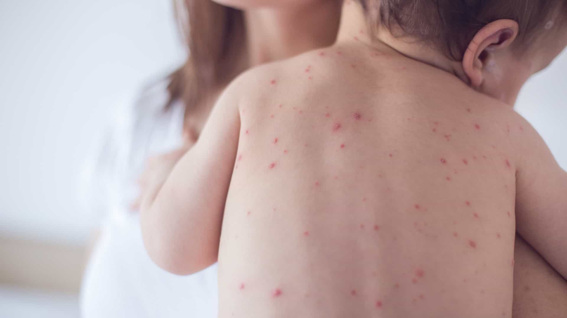 Vacinação de crianças contra sarampo e influenza começa em 4 de abril
