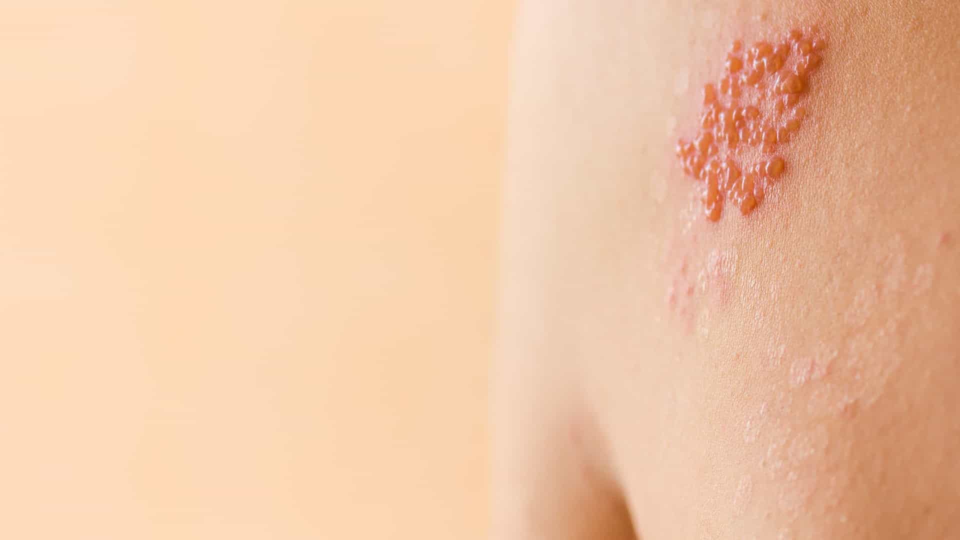 Entenda a relação entre o vírus da catapora e a vacina contra o herpes zoster