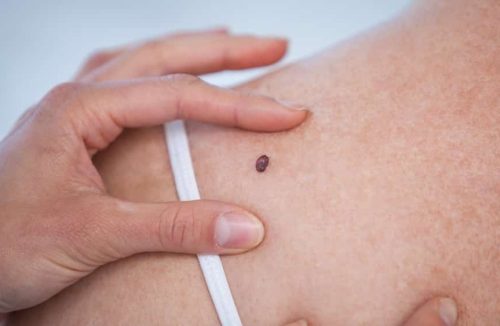 Cientistas encontram novo caminho para tratar tipo mais letal de câncer de pele - Jornal da Franca