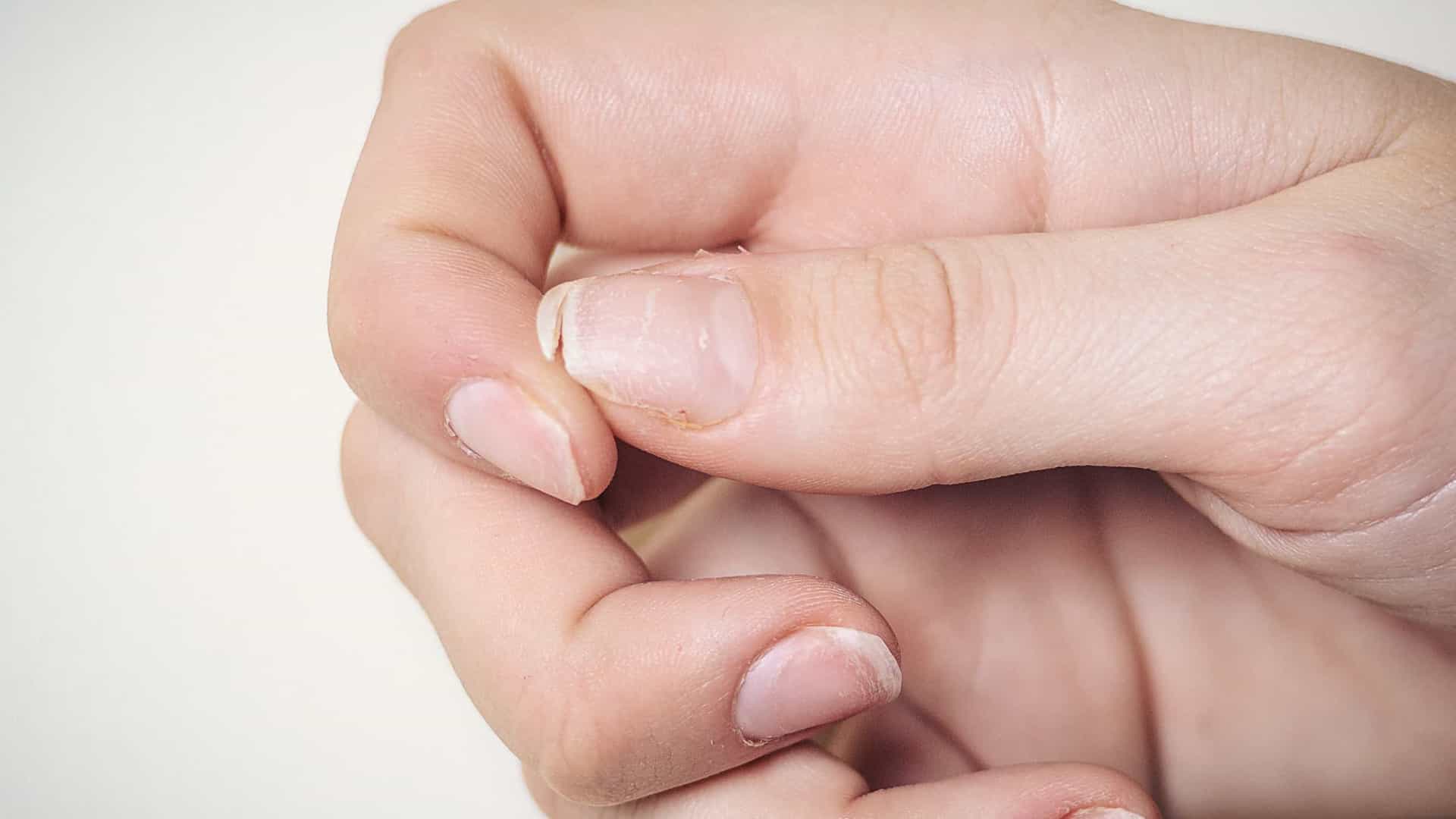 Cinco sinais (além do cansaço) que o corpo dá para indicar que é anemia!