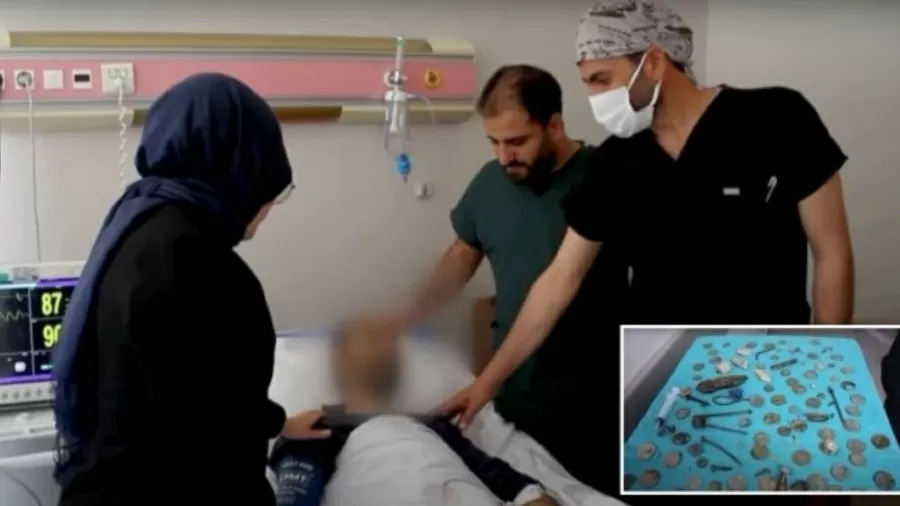 Médicos retiram 233 objetos do estômago de paciente: baterias, moedas, parafusos…