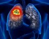 Câncer de pulmão: doença fatal também pode atingir não fumantes – entenda! - Jornal da Franca
