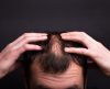 EUA aprovam 1º remédio para alopecia que restaurou cabelos em vários pacientes - Jornal da Franca