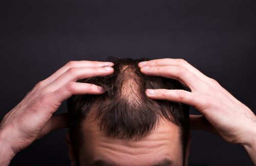 EUA aprovam 1º remédio para alopecia que restaurou cabelos em vários pacientes - Jornal da Franca