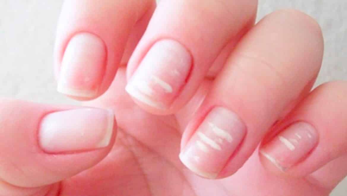 Mudanças nas unhas podem indicar doenças em outras partes do corpo – entenda!