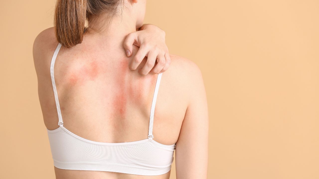 Alergias: conheça as manifestações mais comuns em temperaturas quentes