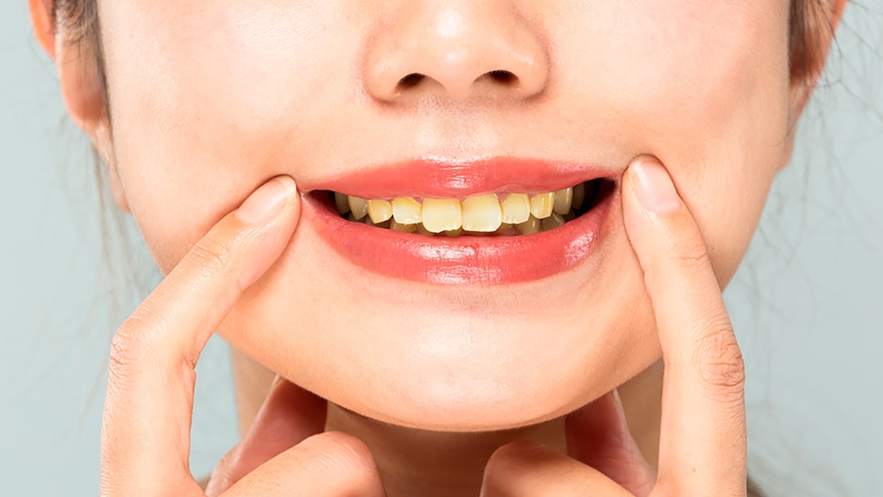 Veja 4 mitos e verdades sobre alimentos e bebidas que amarelam os dentes