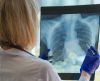 Câncer de pulmão é um dos que têm mais probabilidade de atingir cérebro; entenda - Jornal da Franca