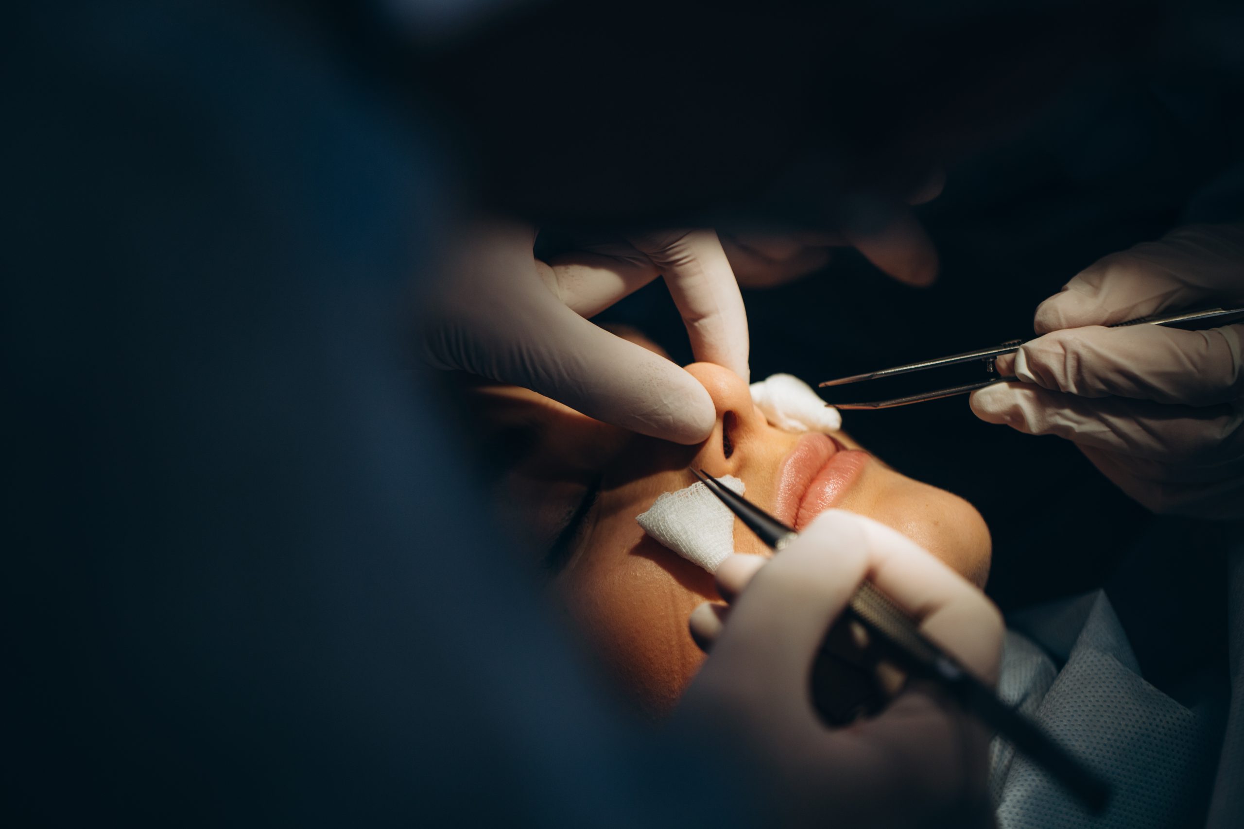 O que é rinoplastia secundária? Conheça os verdadeiros motivos para fazer a cirurgia