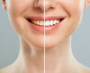 Clareamento dental: Veja os mitos que você tem de deixar de acreditar! - Jornal da Franca