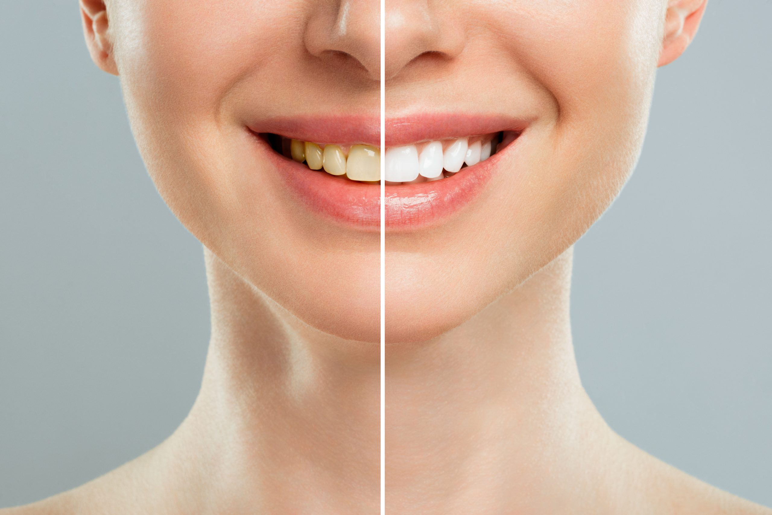 clareamento dental