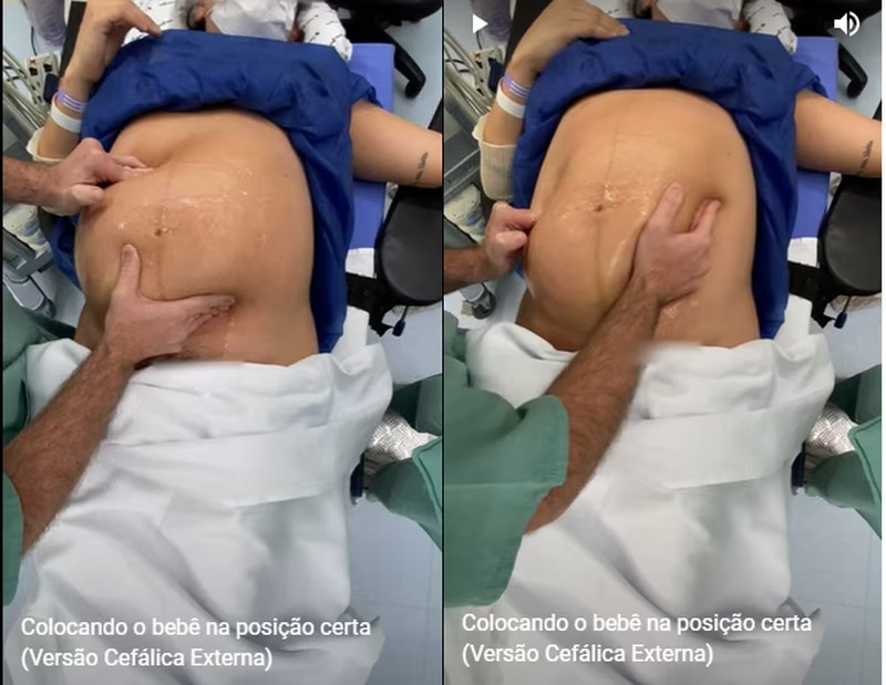 Vídeo impressionante mostra médico virando bebê na barriga da mãe antes do parto