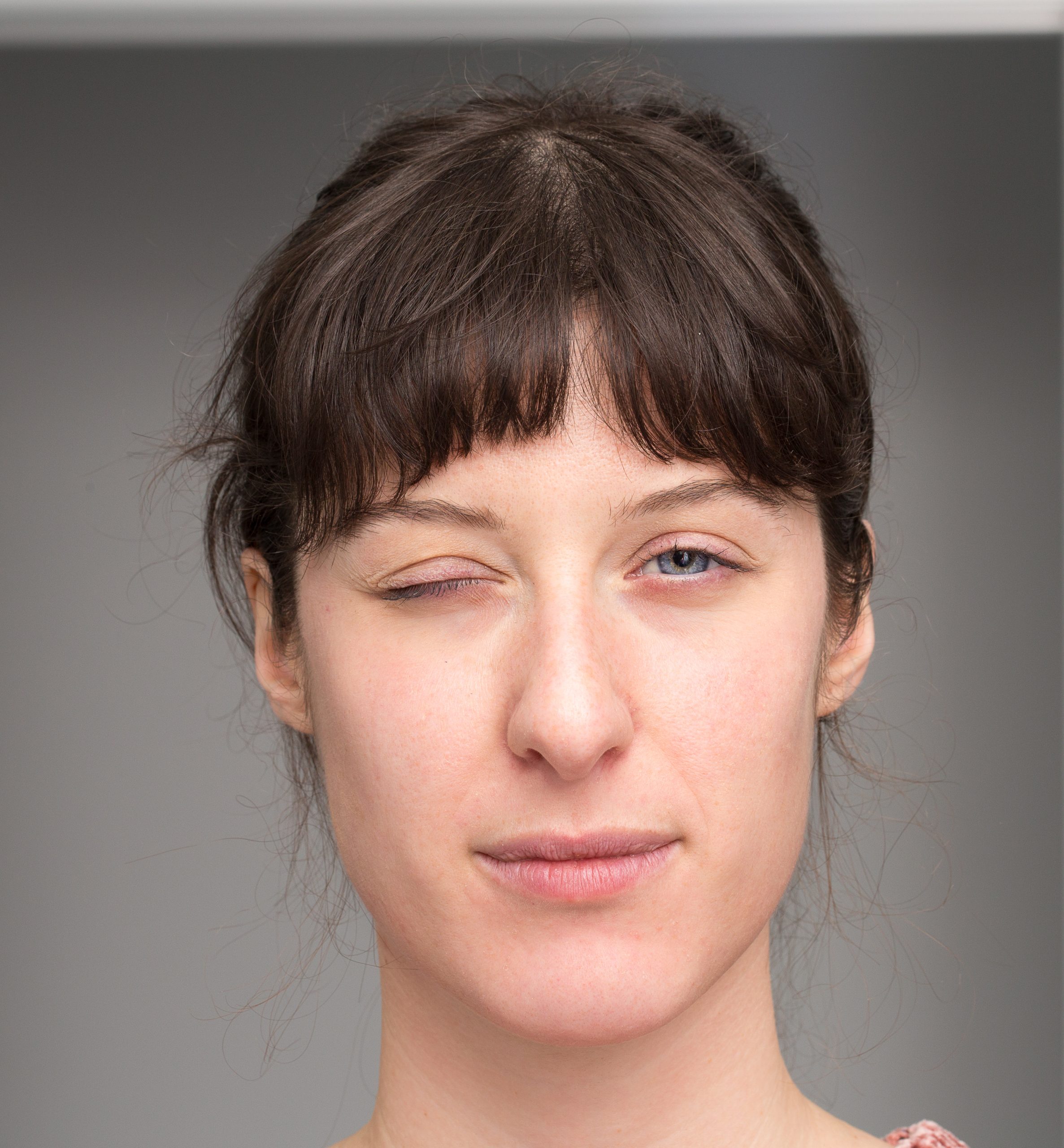 paralisia facial