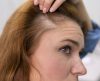Alopecia: Conheça 7 sinais que indicam o surgimento da doença - Jornal da Franca