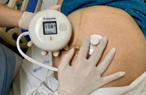 Hapvida e Senai Ceará lançam detector de frequência cardíaca fetal com IA - Jornal da Franca