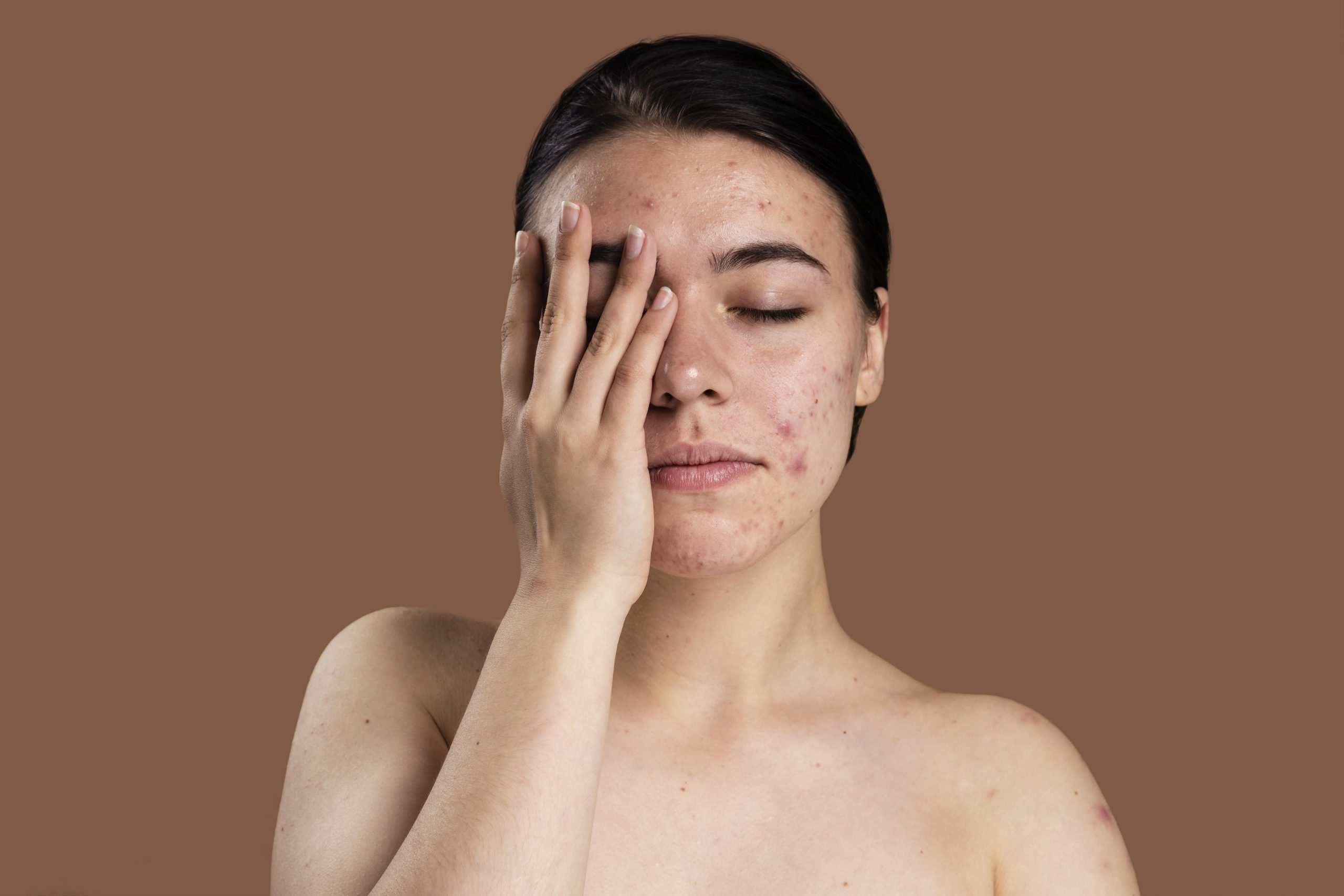 Dermatologistas alertam: excesso de skincare pode piorar acne