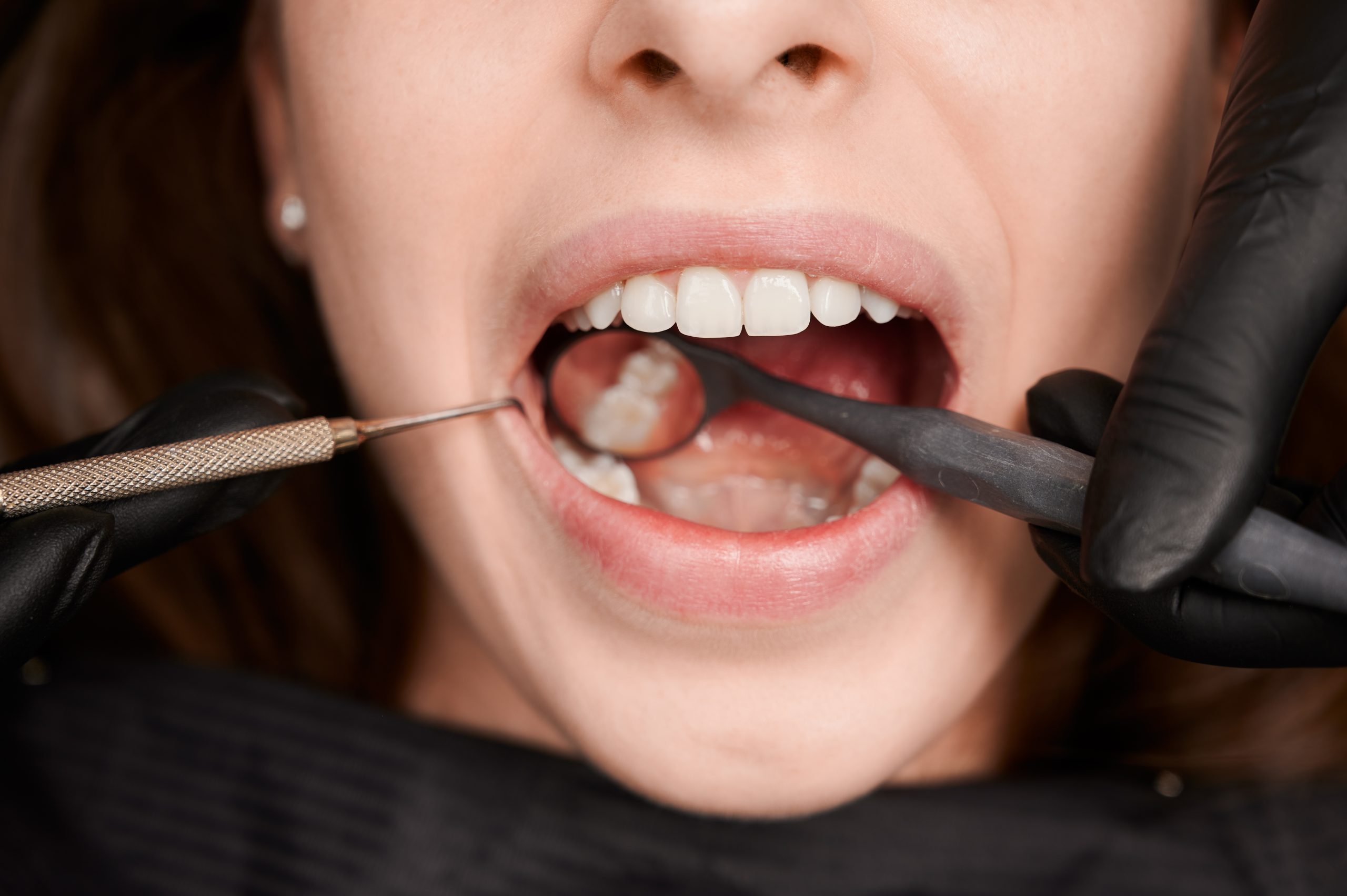 Dente do siso tem idade limite para nascer? Saiba mais sobre este dentinho “levado”