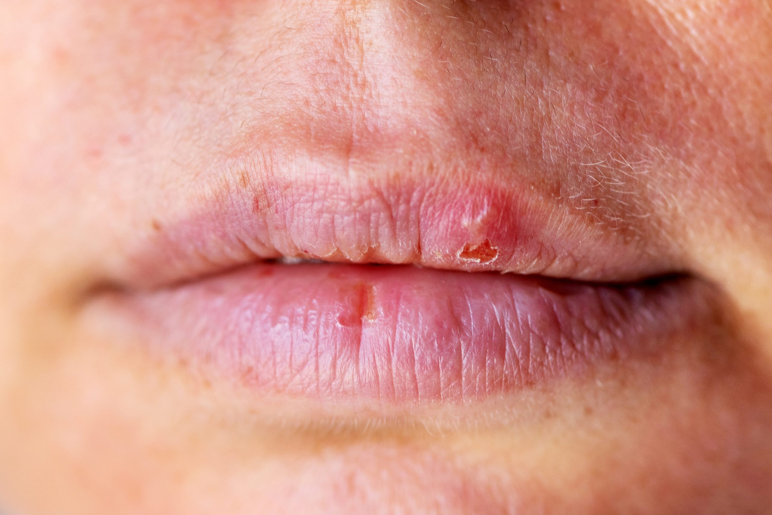 Herpes zóster: Conheça os mitos e verdades sobre a doença