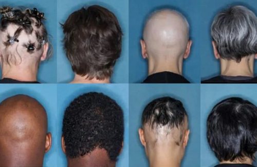 Novo remédio contra queda de cabelo tem “menos eventos adversos”, diz Unicamp - Jornal da Franca