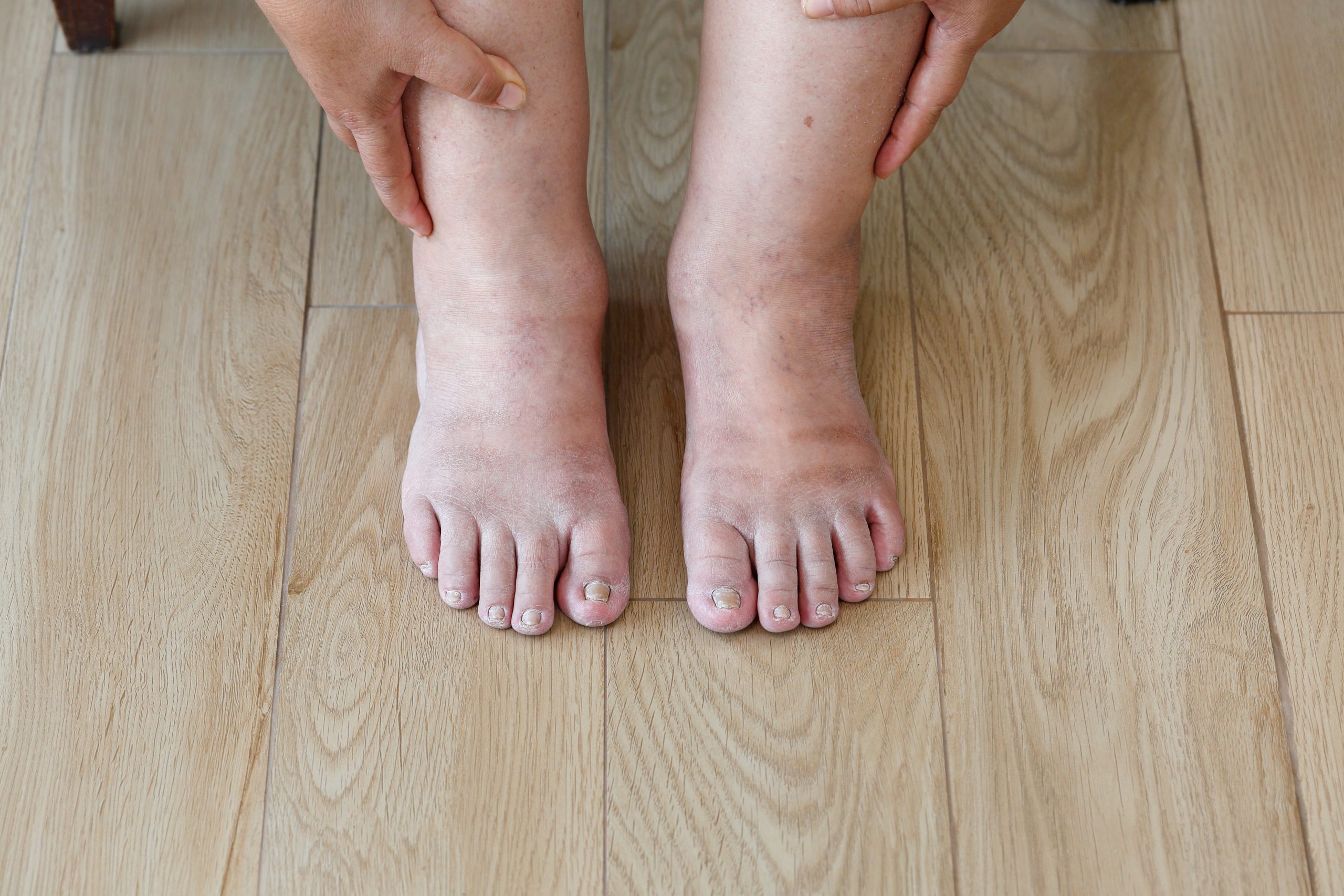 Edema: entenda o que causa o problema e como aliviar o inchaço