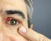 Herpes ocular: saiba o que é, quais são os sintomas e qual o tratamento - Jornal da Franca