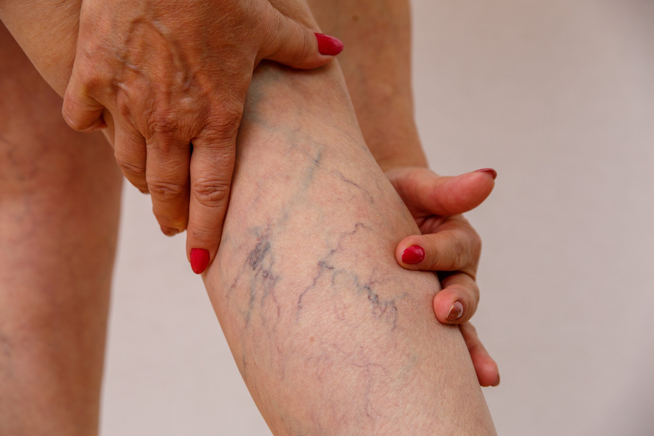 Saiba qual é a relação entre pés frios e pernas pesadas com varizes