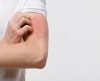 SOS Alergias: veja as 5 doenças de pele mais comuns no verão - Jornal da Franca