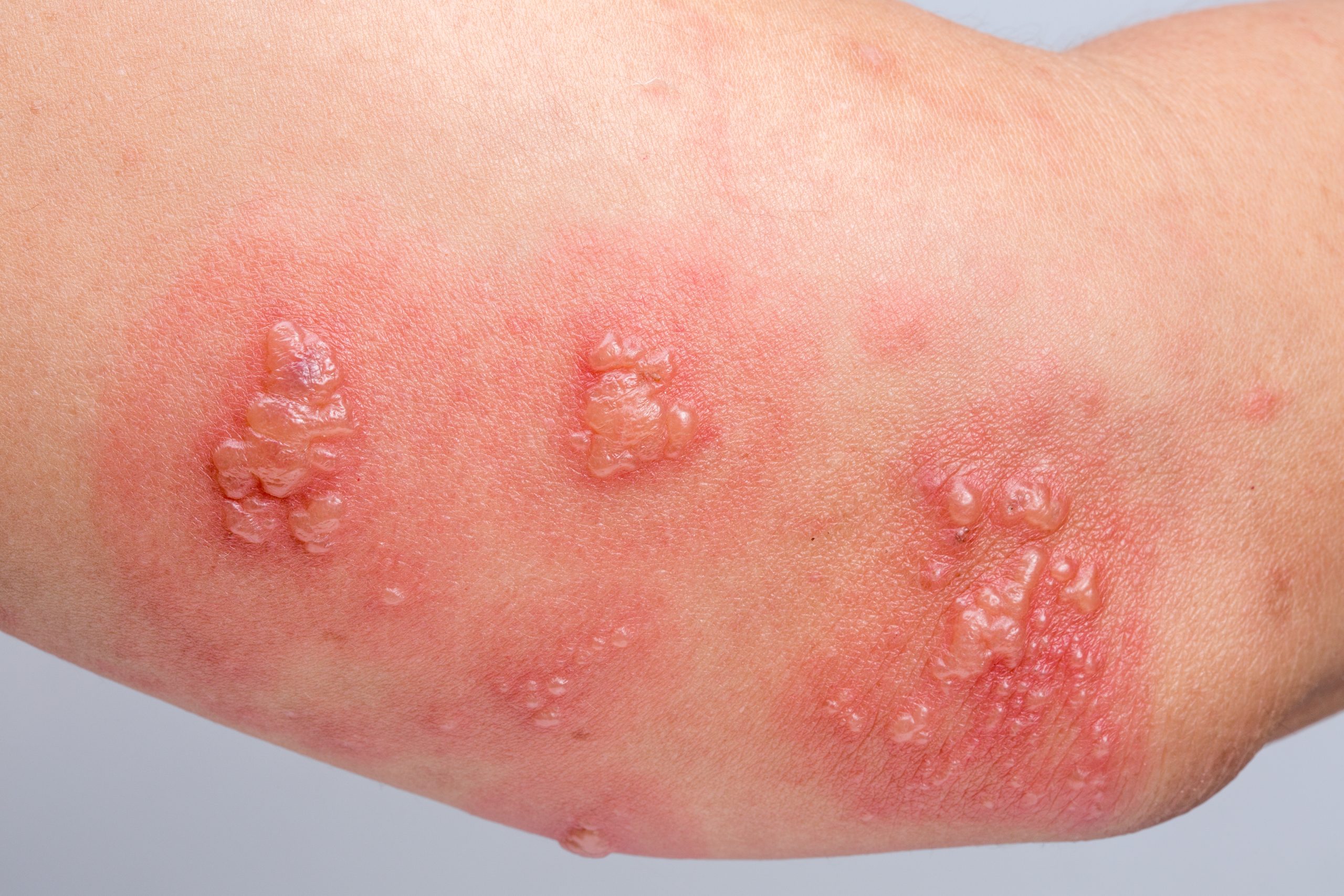 Dor pós herpes-zóster: médica revela como tratar o problema