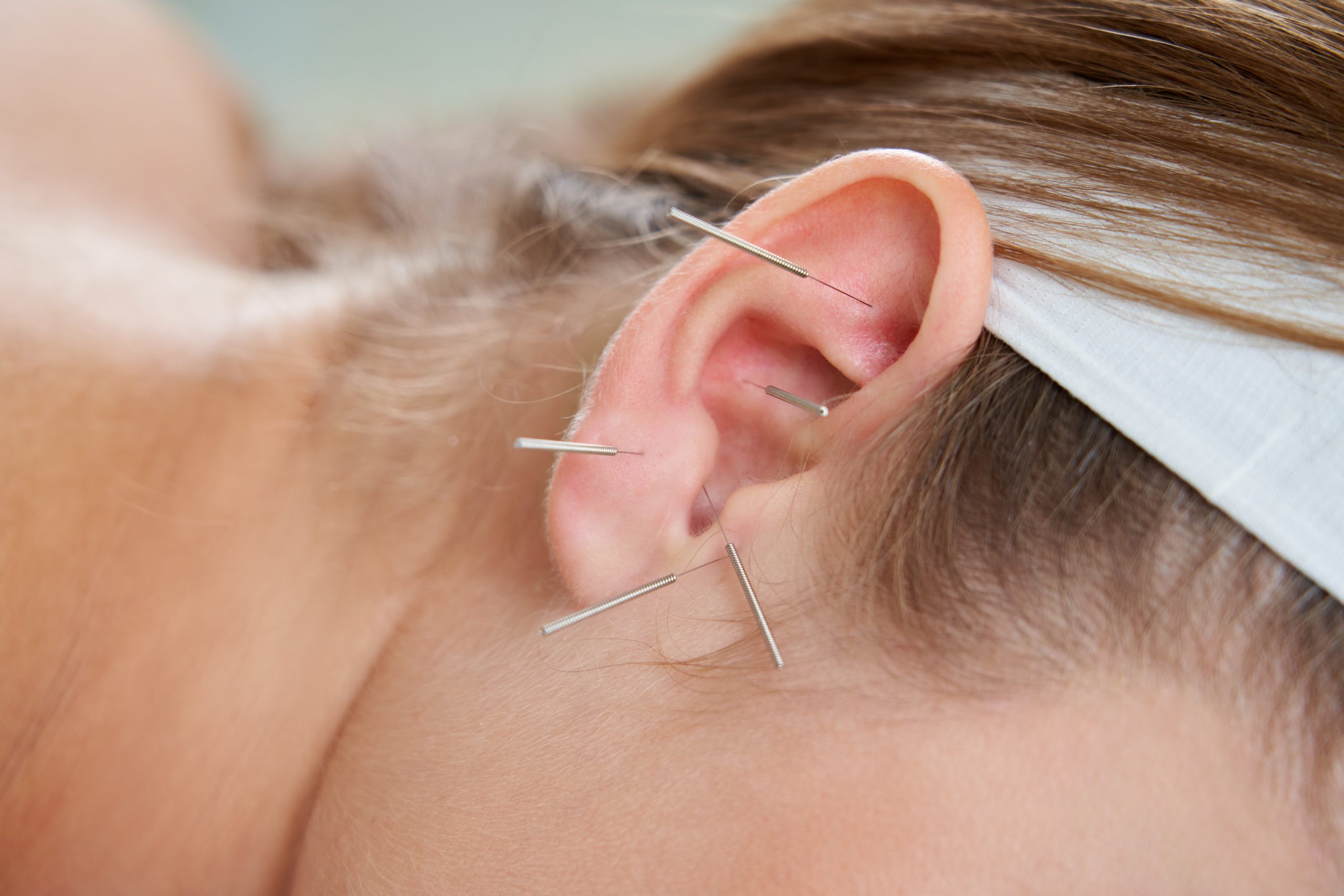 Estudo confirma benefício da acupuntura auricular no tratamento da depressão