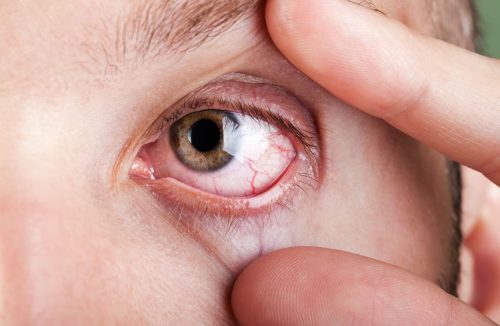 Olhos lacrimejando podem ser sintoma de dengue? Veja o que dizem os especialistas - Jornal da Franca