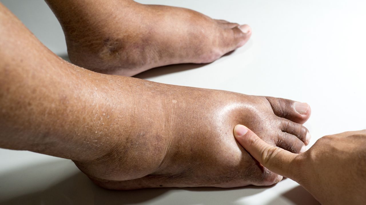 Lipedema e linfedema: você sabe a diferença? Especialista explica