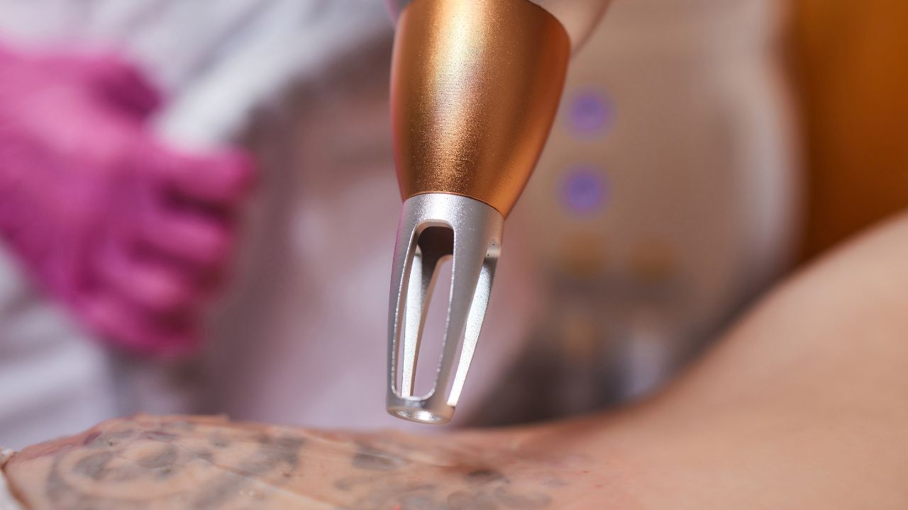 Remover ou cobrir a tatuagem? Veja qual a melhor opção antes de decidir