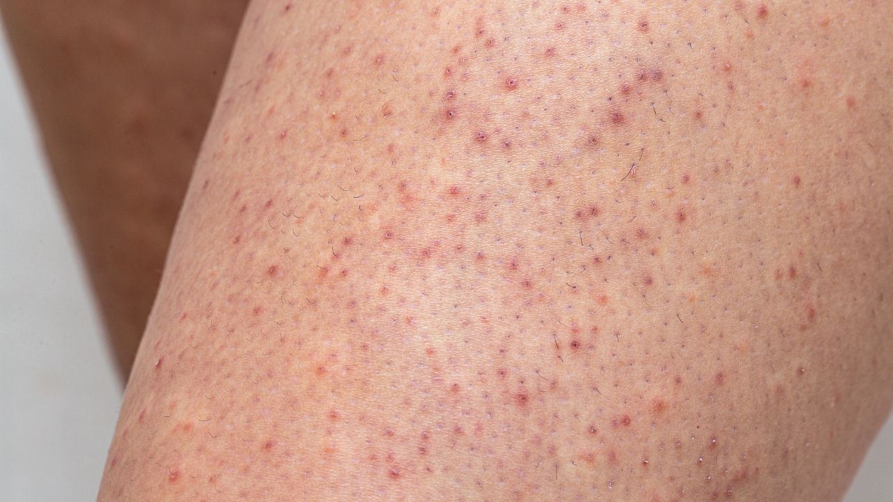 Queratose pilar: saiba o que é, quais as causas e como tratar o problema