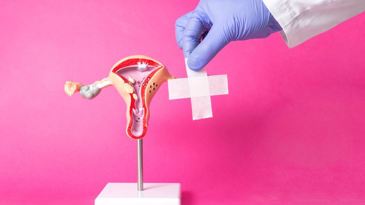 Mioma: 3 coisas que você precisa saber sobre a doença