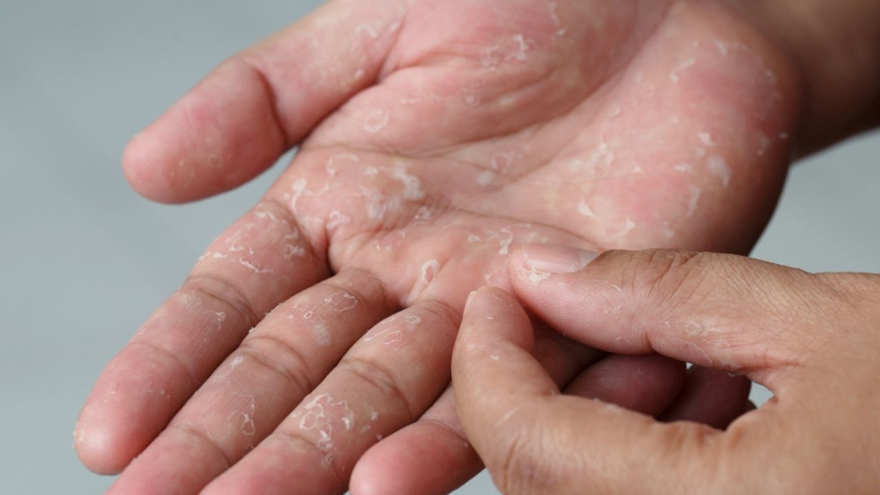 Bolhas nos pés e nas mãos pode ser disidrose; conheça problema