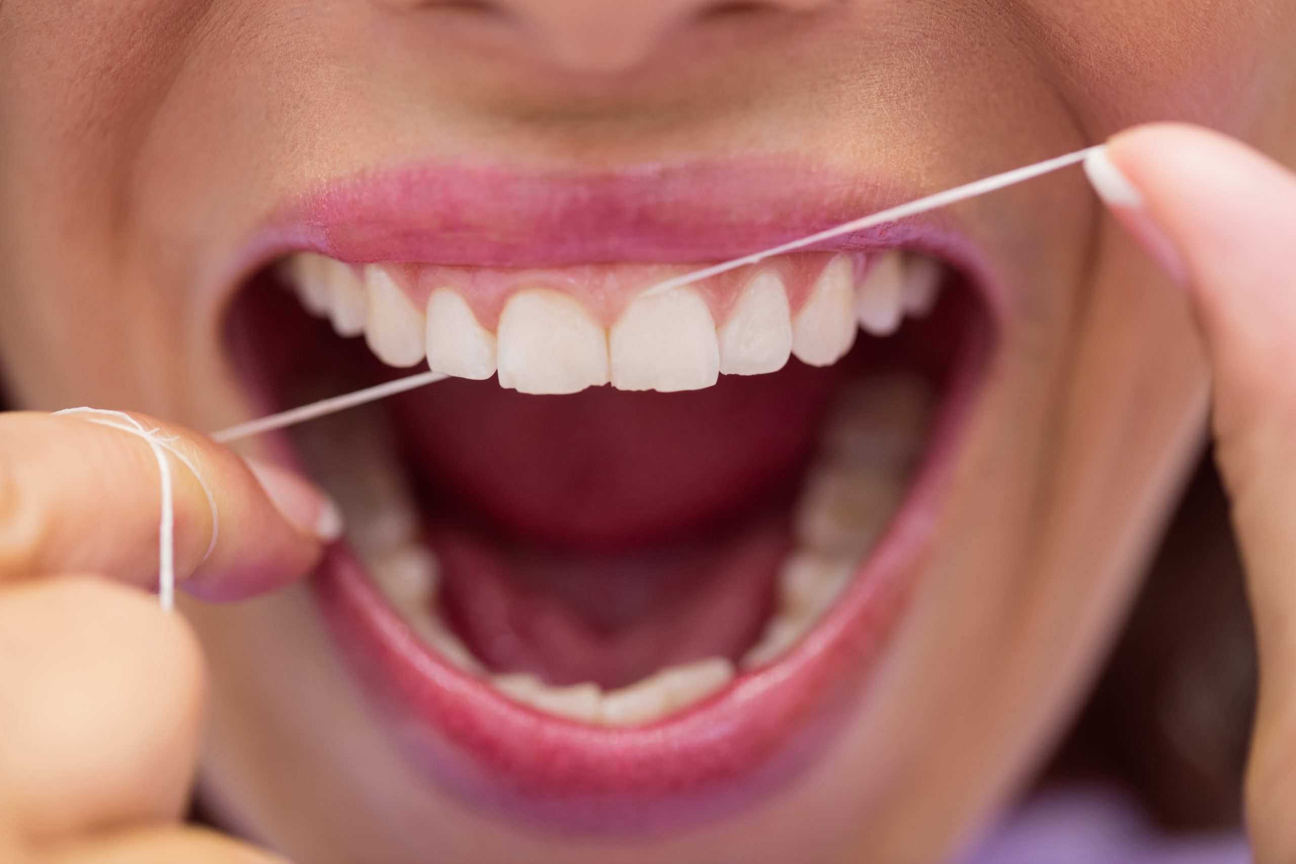 Uso regular de fio dental pode reduzir risco de AVC, aponta estudo