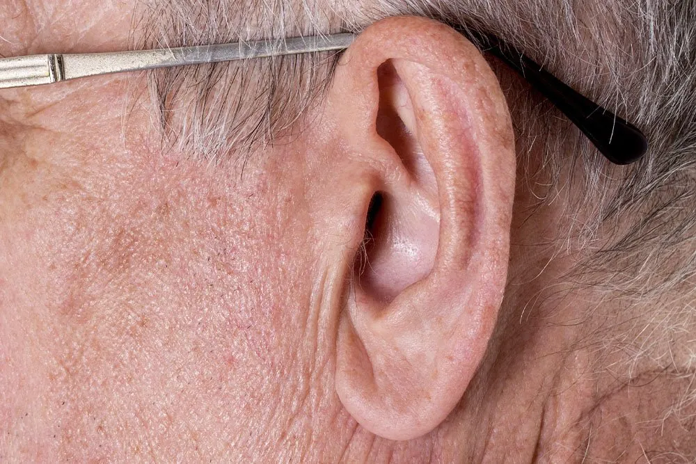 Sinal de Frank: marca na orelha indica risco real de infarto? Entenda
