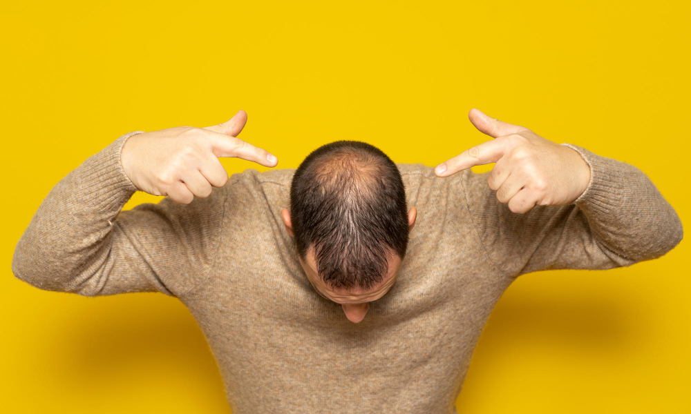 Shampoos ajudam contra a calvície? Entenda o que é mito e o que é verdade