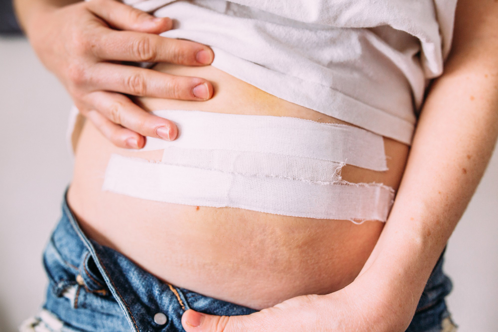 Hérnia Abdominal: O problema que pode virar um caso de urgência cirúrgica