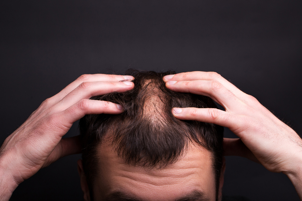 Cabelo cai mais no frio? Médicos explicam o impacto do inverno na saúde capilar
